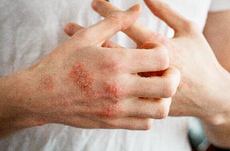 DU_KERTYOL P-S-O-_SILO_PSORIASIS_CAUSES_CONTENT_BANNER